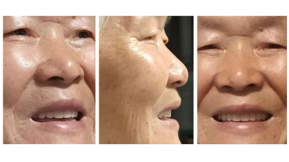 Dr. Hua Zhu's aunt with her new dentures 